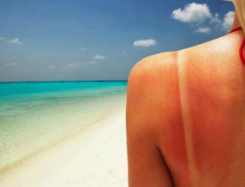 7 rimedi naturali contro le scottature solari